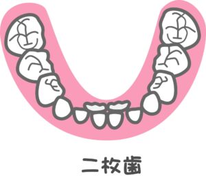 二重歯列