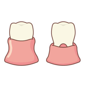 歯茎が下がる