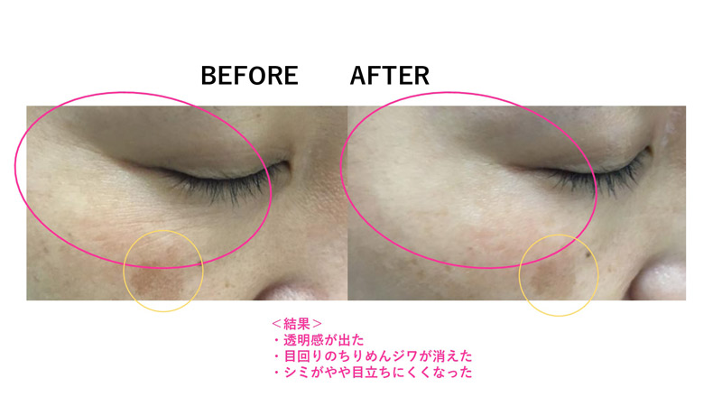 目の周りの小じわ改善