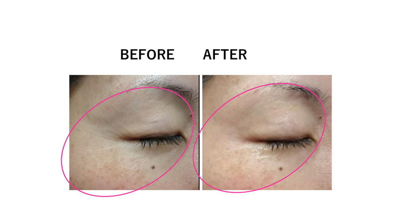 目の周りの小じわ改善
