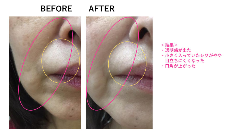 ほうれい線改善